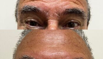Antes e depois do botox 1