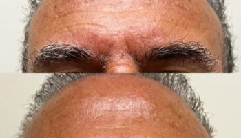 Antes e depois do botox