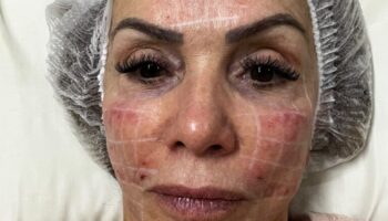 Laserterapia 2