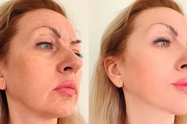 Preenchimento facial Preenchimento facial