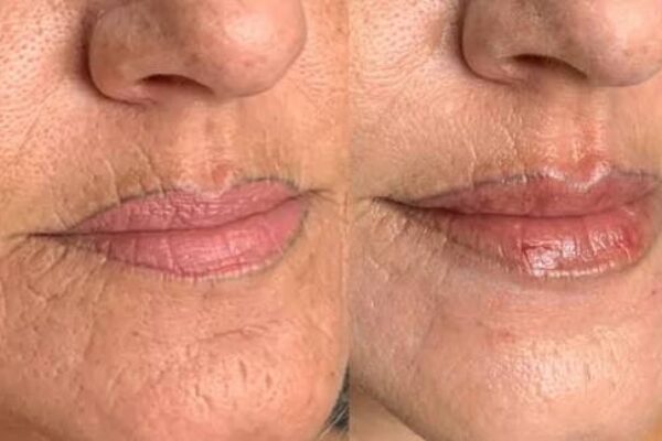 Preenchimento labial Preenchimento labial