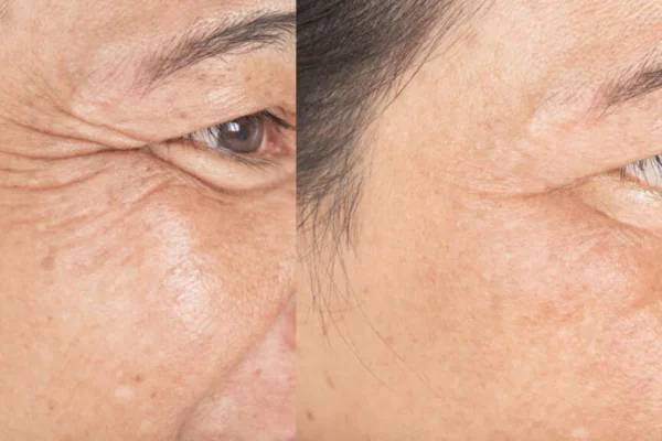 Ultraformer - antes e depois Ultraformer - antes e depois
